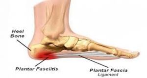 Plantar Fasciitis Treatment in Kolkata