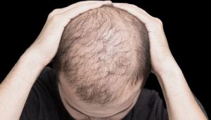 Hair Transplantation