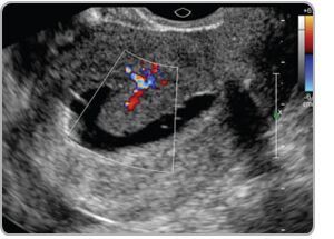 Sonohysterography