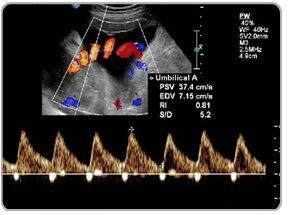 Uterine Artery Doppler Scans