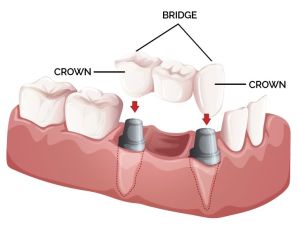 Orthodontic Braces