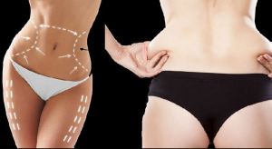 Body Contouring Surgery