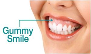 Gummy Smile Correction Treatment Services