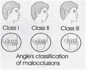 Malocclusion Dental Treatment Services