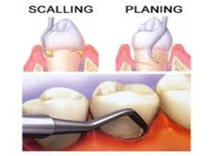 Scaling Root Planing Treatment Services