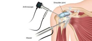 Shoulder Arthroscopy