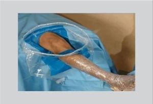 Sms Arthroscopic Drape