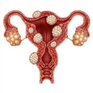 Fibroid Surgery