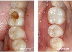 zirconia crown