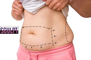 tummy tuck surgery