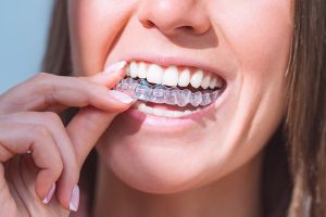 invisalign services