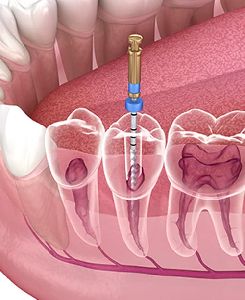 Root Canal Treatment