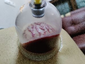 Hijama Cupping Therapy