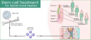 Stem Cell Treatment For Spinal Cord Injury