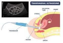 Transvaginal Sonography