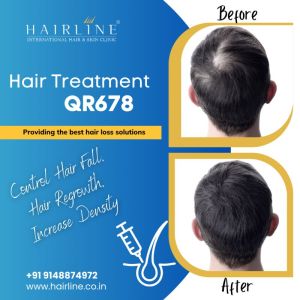 QR - 678 Hair Growth Treatment