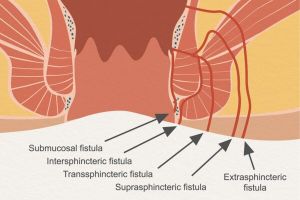 fistula