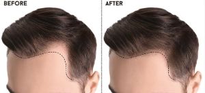 Professional Hair Transplantation in Punjab