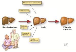 Non alcoholic fatty liver disease Treatment