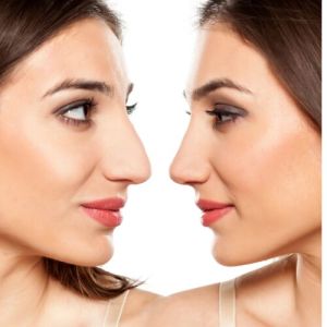 Rhinoplasty Surgery