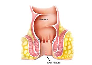 fissurectomy