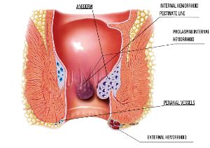 Hemorrhoidectomy