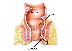 laser fistula surgery