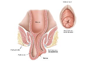 laser rectal prolapse surgery