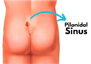 pilonidal cystectomy surgery