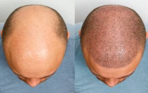 Hair Transplant Surgery in Ahmedabad