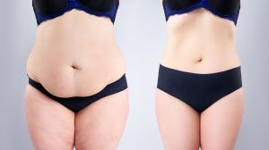 Tummy Tuck Surgery in Ahmedabad