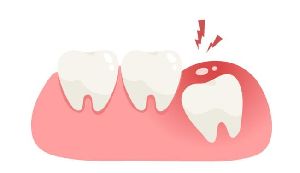 dental impaction