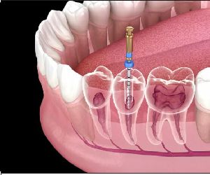 Root Canal Treatment(RCT)