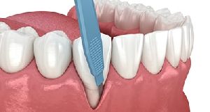 Composite Fillings