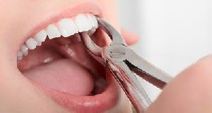 dental extraction