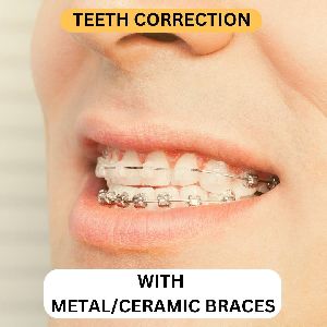 Metal & Ceramic Braces