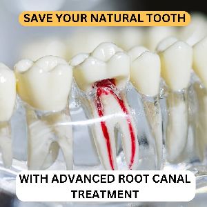 Root Canal Treatment