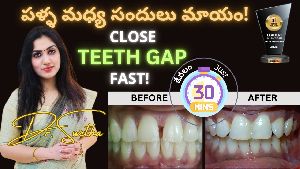 teeth gap treatment