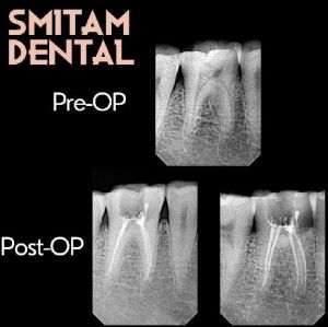 Microscopic Root Canal treatment