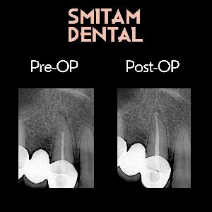 Re-Root Canal Treatment