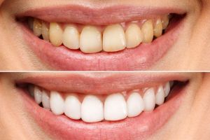 Teeth Whitening Services