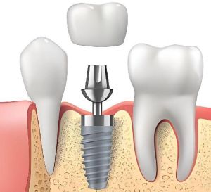 Tooth Replacement