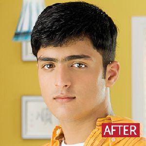 Hair Transplant Service