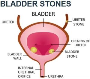 Bladder Stone Removal Service