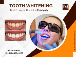 Teeth Whitening Services