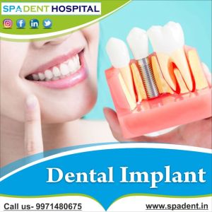 Dental Implant