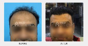 FUE hair transplant in Delhi