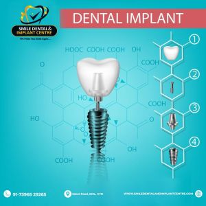 Dental Implants