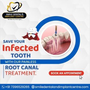 Root Canal Treatment