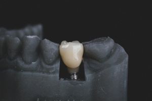 Dental Implant Surgery